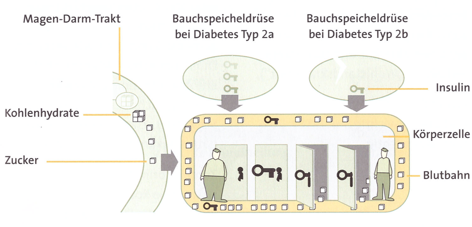 schematische Darstellung Typ 2 Diabetes